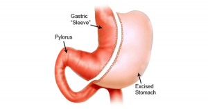 gastric bypass surgery cost