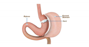 mini gastric bypass surgery