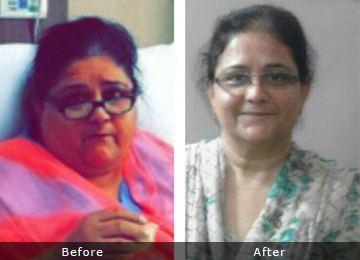 surgery for weight loss