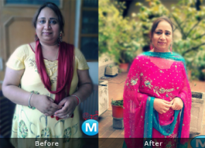 surgery for weight loss