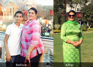 surgery for weight loss