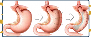 Gastric Bypass Complications