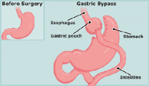 gastric bypass surgery cost