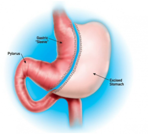 Laparoscopic Gastrectomy surgery