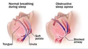 Treatment of sleep Apnea