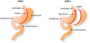 Grastric Sleeve Surgery