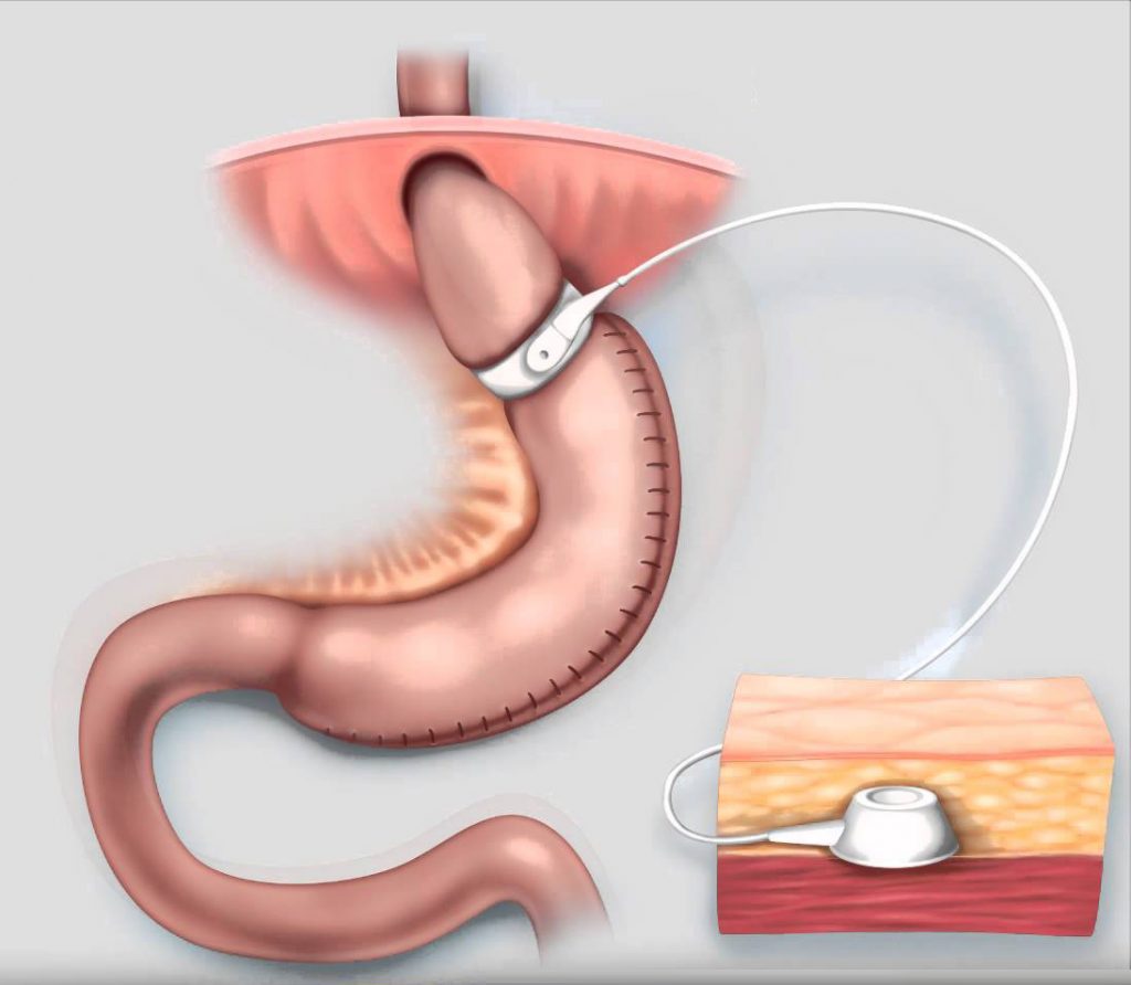 Adjustable Gastric Banded Plication Dr.Amrit Garg