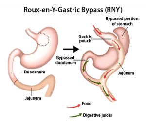Roux-e Y Gastric bypass
