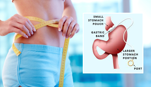 gastric band surgery