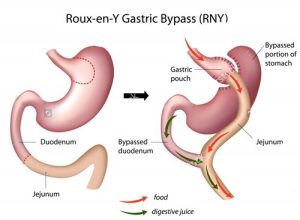 Roux-En-Y Gastric Bypass