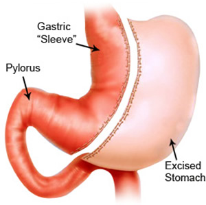sleeve gastrectomy surgery