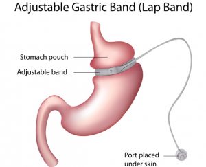 Adjustable Gastric Band
