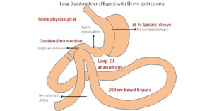 sleeve gastrectomy surgery