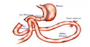 surgery for diabetes