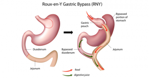 Roux-e Y Gastric bypass