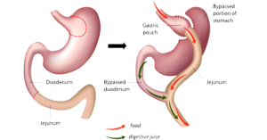 gastric bypass surgery cost