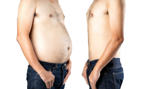 sleeve gastrectomy surgery