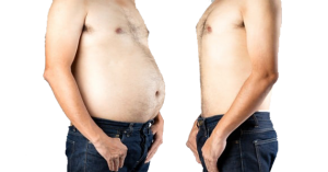 surgery for weight loss
