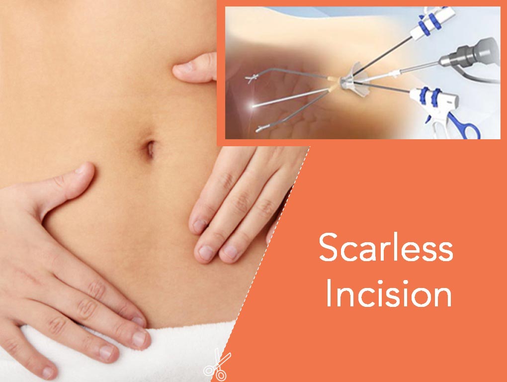 Scarless Incision