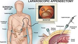 Laparoscopic