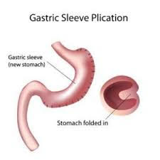 gastric sleeve
