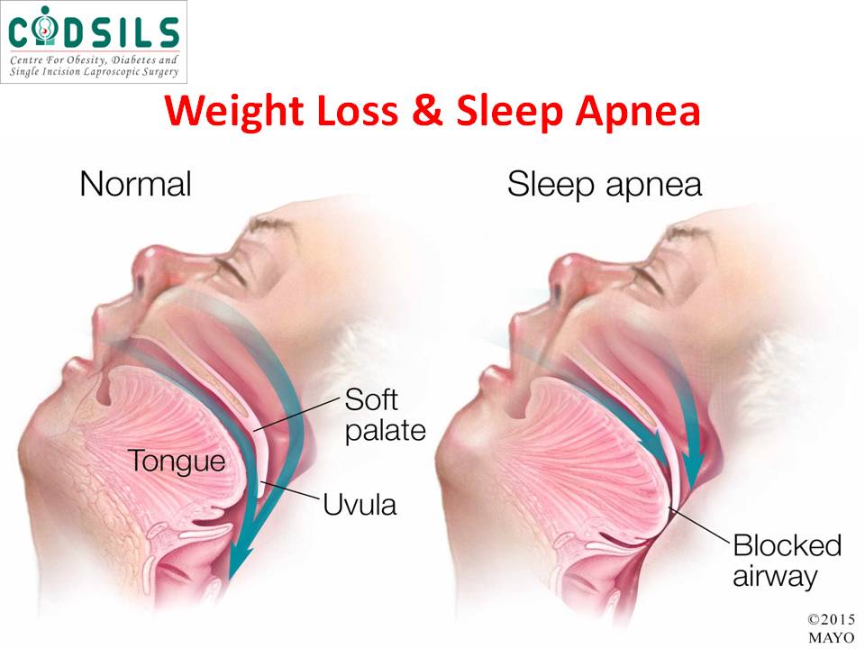 Can You Get Rid Of Sleep Apnea If You Lose Weight Weight Loss And Sleep Apnea Sleep Apnea Weight Loss