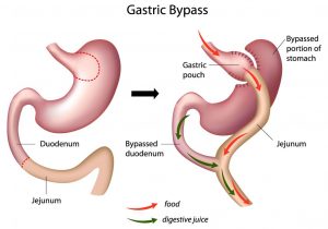 Mini Gastric Bypass Surgeon Punjab