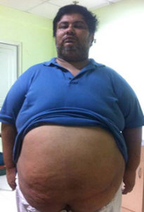 before bariatric harminder