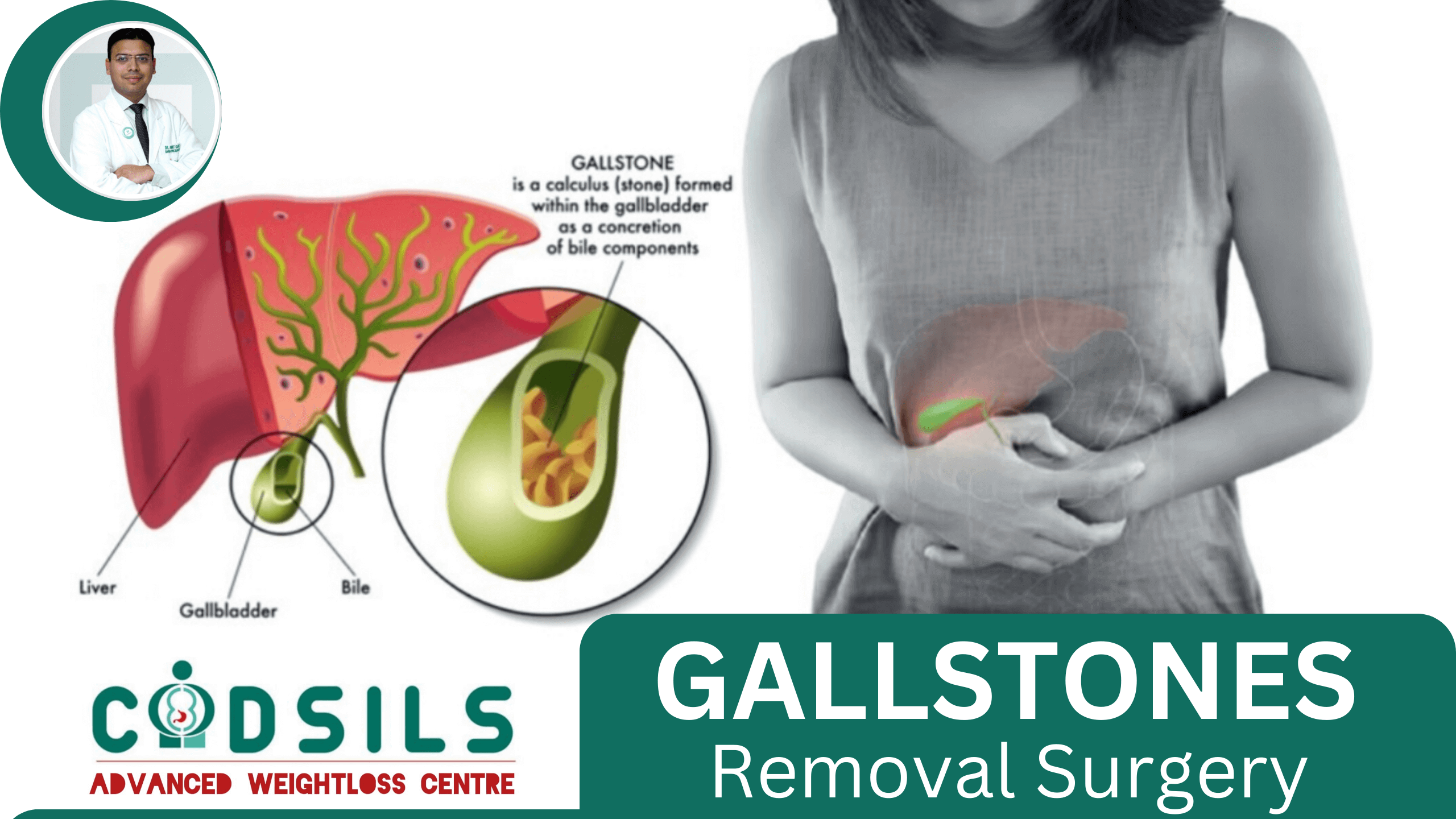 Gallstones Removal Surgery