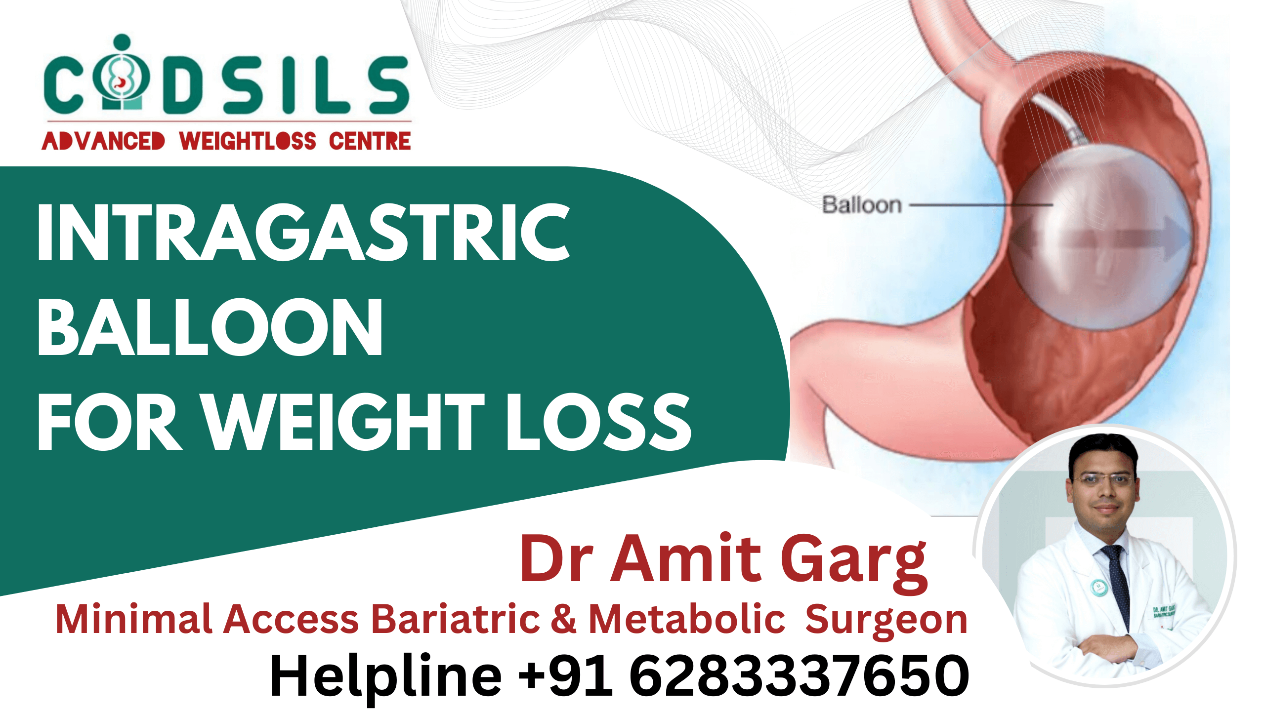 intragastric balloon for weight loss