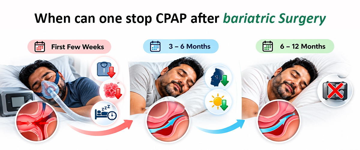 weight loss surgery for sleep apnea